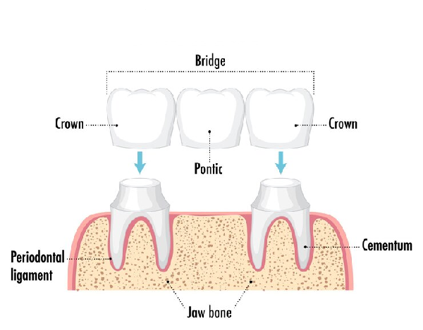 Crown and Bridges